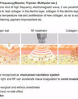 Principles of Radio Frequency Skin Tightening 