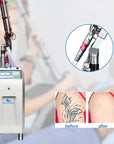 tattoo removal probe