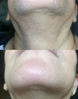 Chin and neck, before and after laser hair removal treatment 