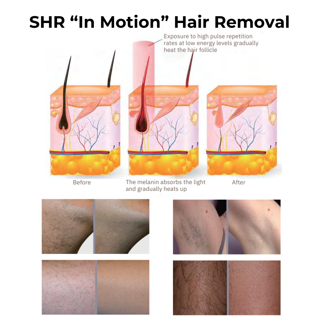 DermaLaze Skin Rejuvenation System with IPL SHR &amp; E-Light