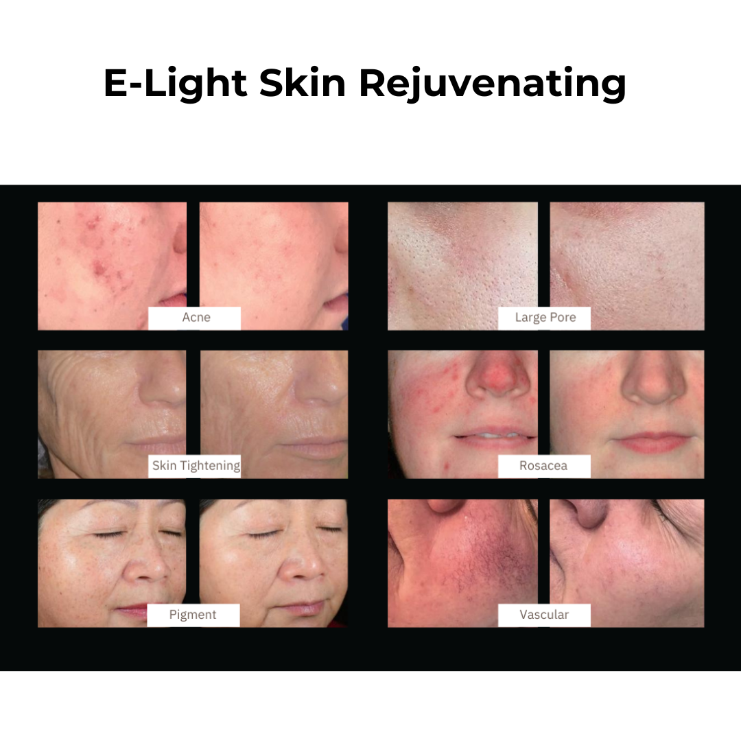 DermaLaze Skin Rejuvenation System with IPL SHR &amp; E-Light