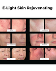 DermaLaze Skin Rejuvenation System with IPL SHR & E-Light