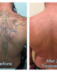 Tattoo removal performance