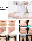 comparison after using fat freezing machine