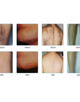 Before and after IPL hair removal  treatment on Underarms, chin back, legs