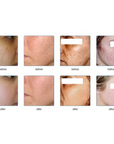 Before and after skin rejuvenating IPL treatment on Face