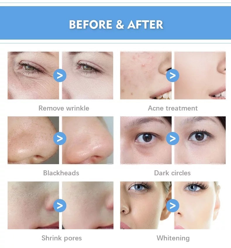 Before and After Use of  Hydrafacial Machine, remove wrinkle, acne, blackhead, dark circles, shrink pores, whiten