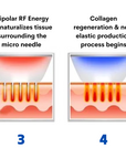 RF collagen regeneration treatment