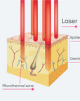 CarbonFrax Pro CO2 Fractional Laser