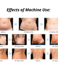 9 in 1 Lipo Cavitation Machine Before and After Effect on Stomach and Back